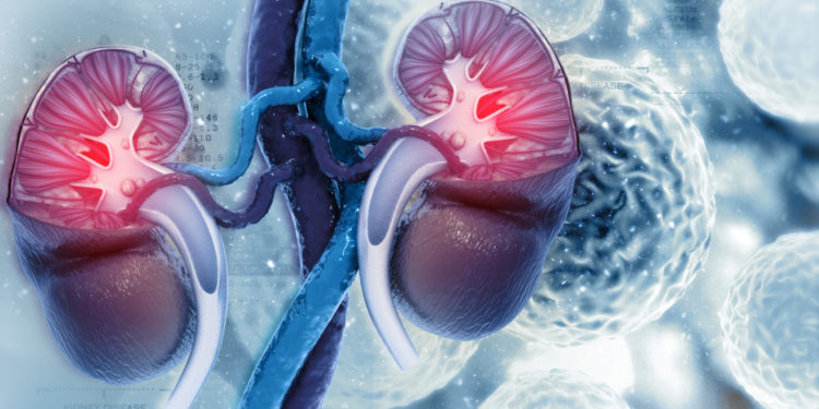 Cáncer Renal provoca más de 3,000 muertes al año