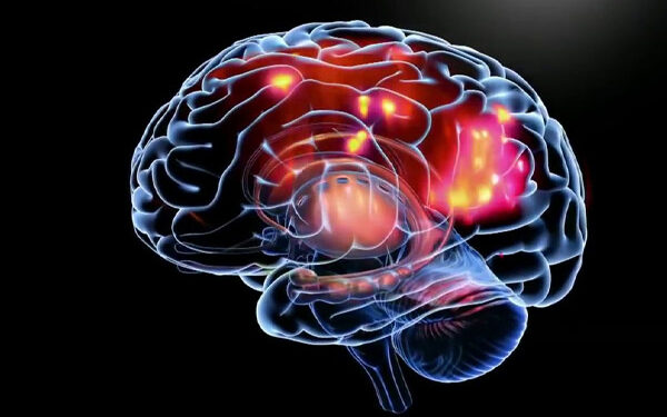 Epilepsia: Un trastorno neurológico que afecta a miles en RD