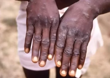 La OMS dice que la viruela del mono no es una nueva COVID