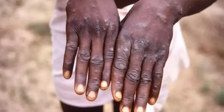 La OMS dice que la viruela del mono no es una nueva COVID