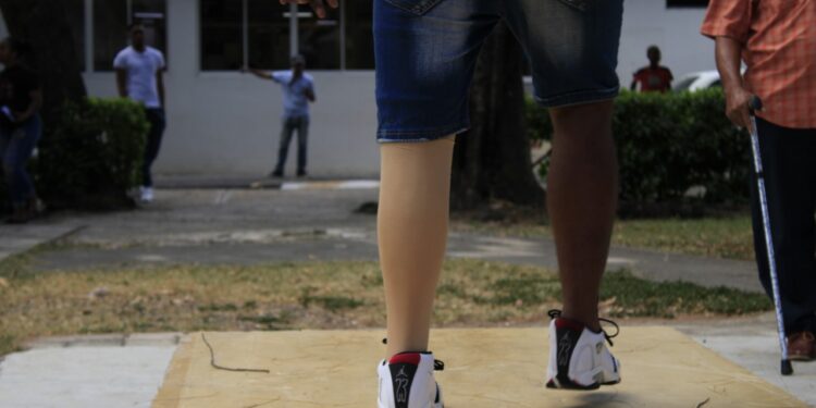 Rehabilitación y 2FT Prosthetics donan 75 prótesis femorales a amputados