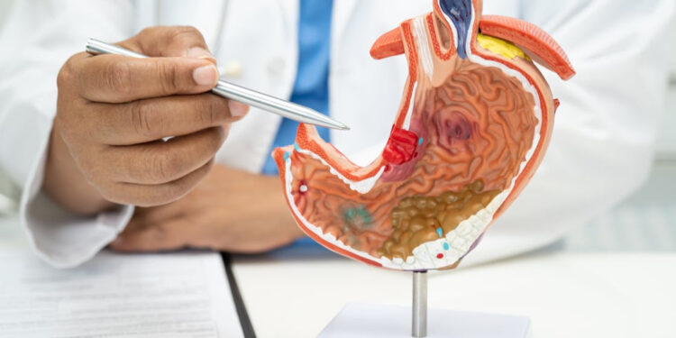 Cáncer de páncreas puede prevenirse con hábitos saludables